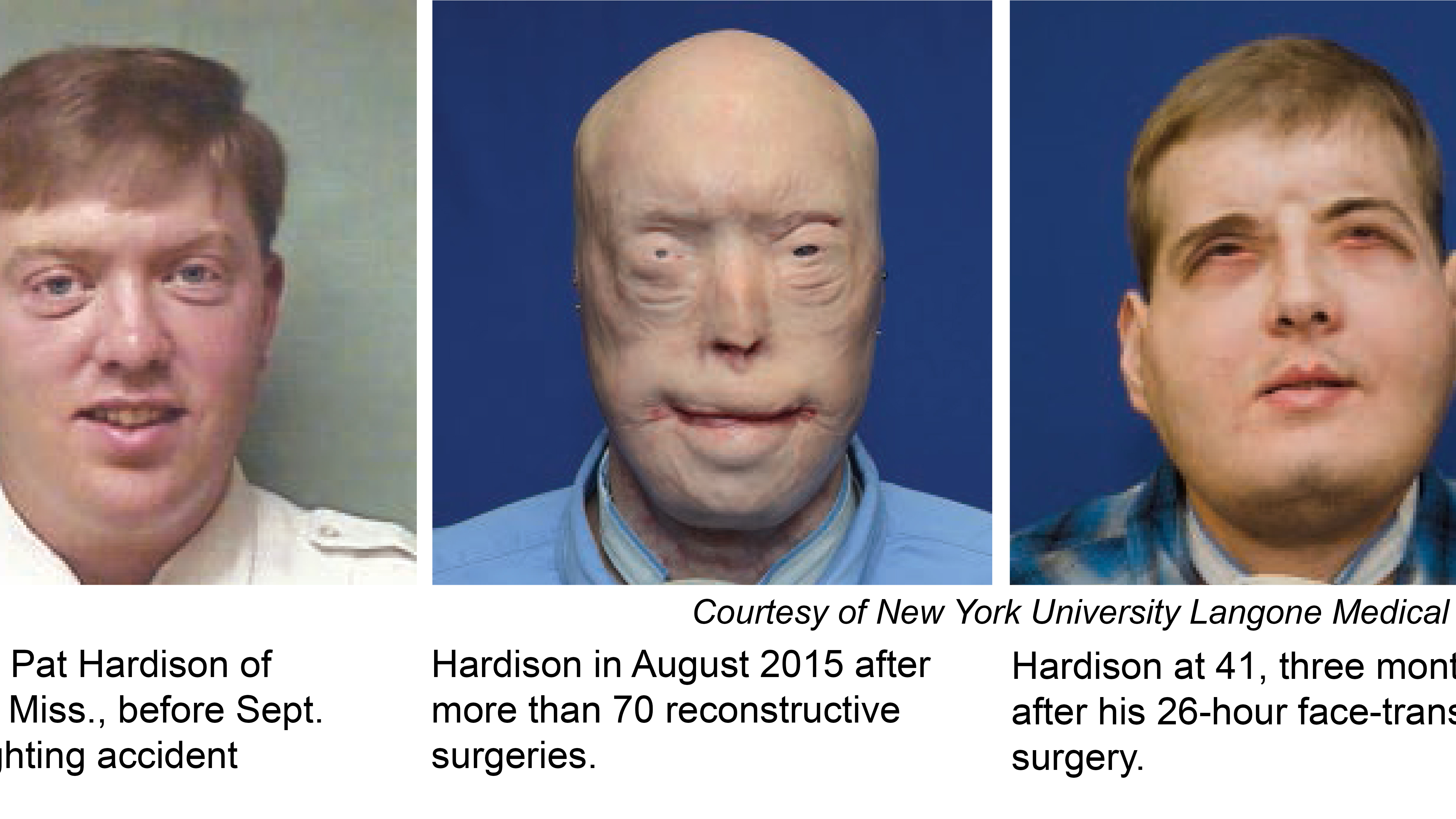 Face Transplant Gives New Hope To Mississippi Firefighter Kgw Com
